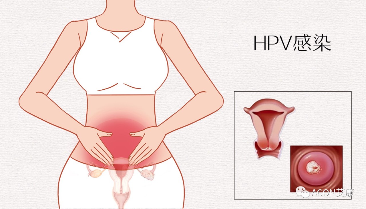 HPV轉(zhuǎn)陰其實很簡單， 女性必知的宮頸癌真相