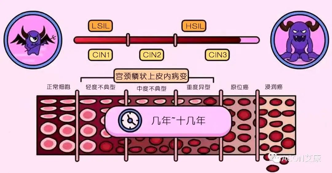 HPV轉(zhuǎn)陰其實很簡單， 女性必知的宮頸癌真相