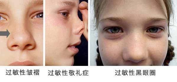 過敏性鼻炎會讓孩子變傻？！家長該如何應(yīng)對